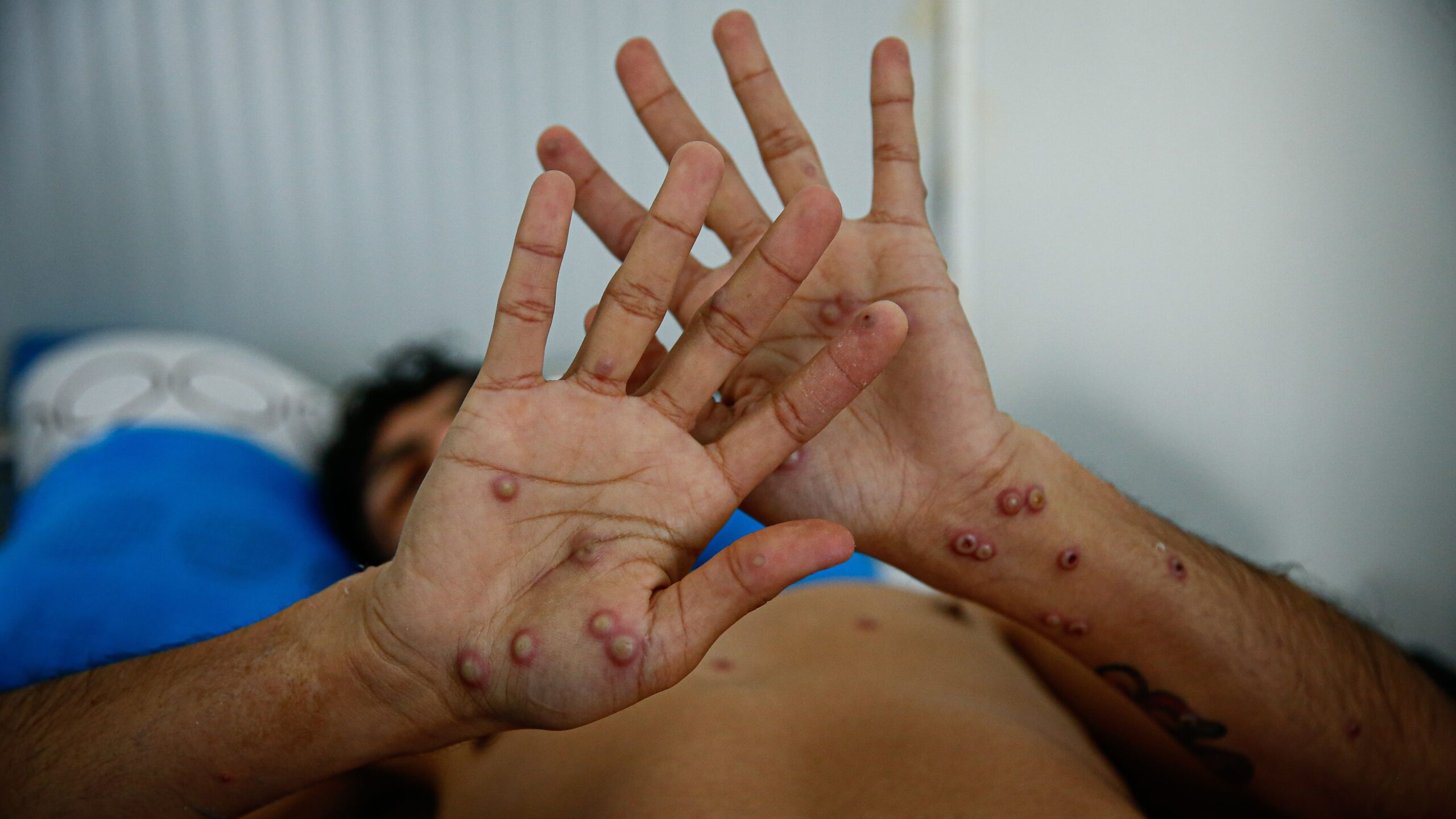 Galicia, con varios casos notificados del virus mpox, propone aplicar medidas en los medios de transporte