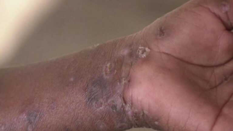 Questions et réponses sur la mpox ou la variole du singe : que faut-il savoir ?
