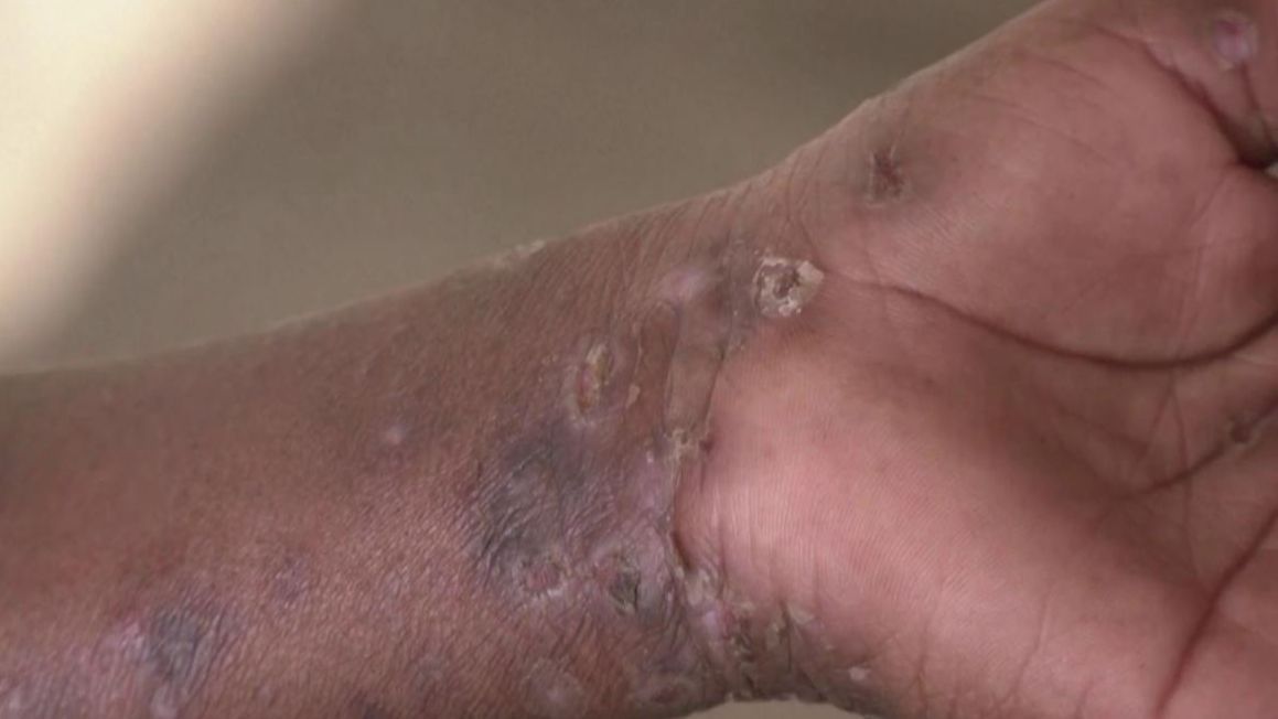 Questions et réponses sur la mpox ou la variole du singe : que faut-il savoir ?
