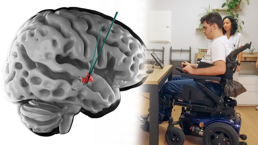 Lésion du cerveau et de la moelle épinière.